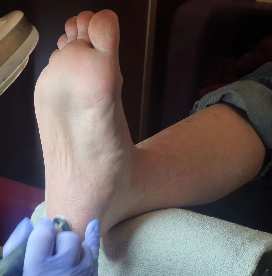 Натоптыши и мозоли