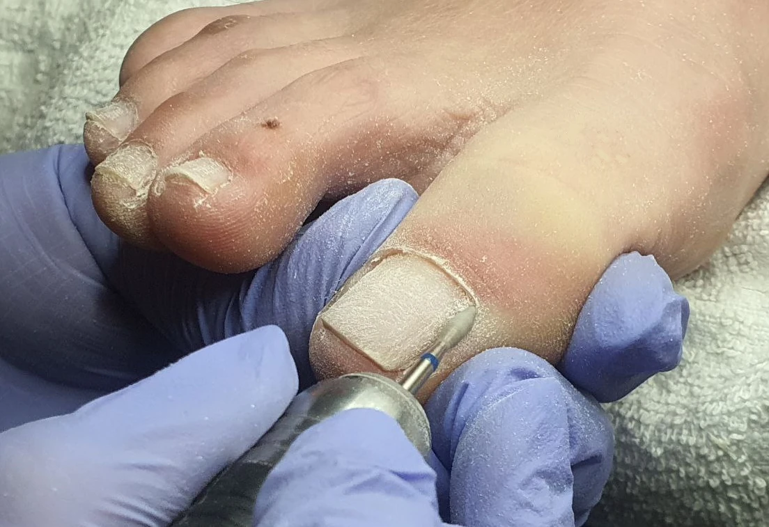 Обработка ногтей на ногах