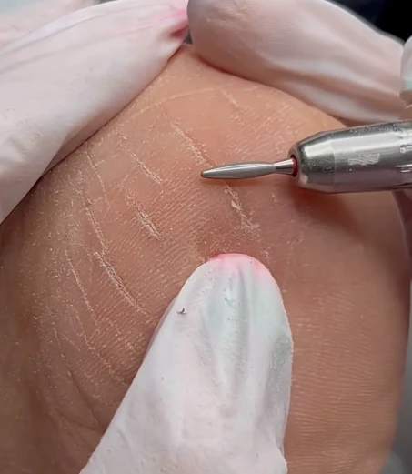 Трещины на пятках