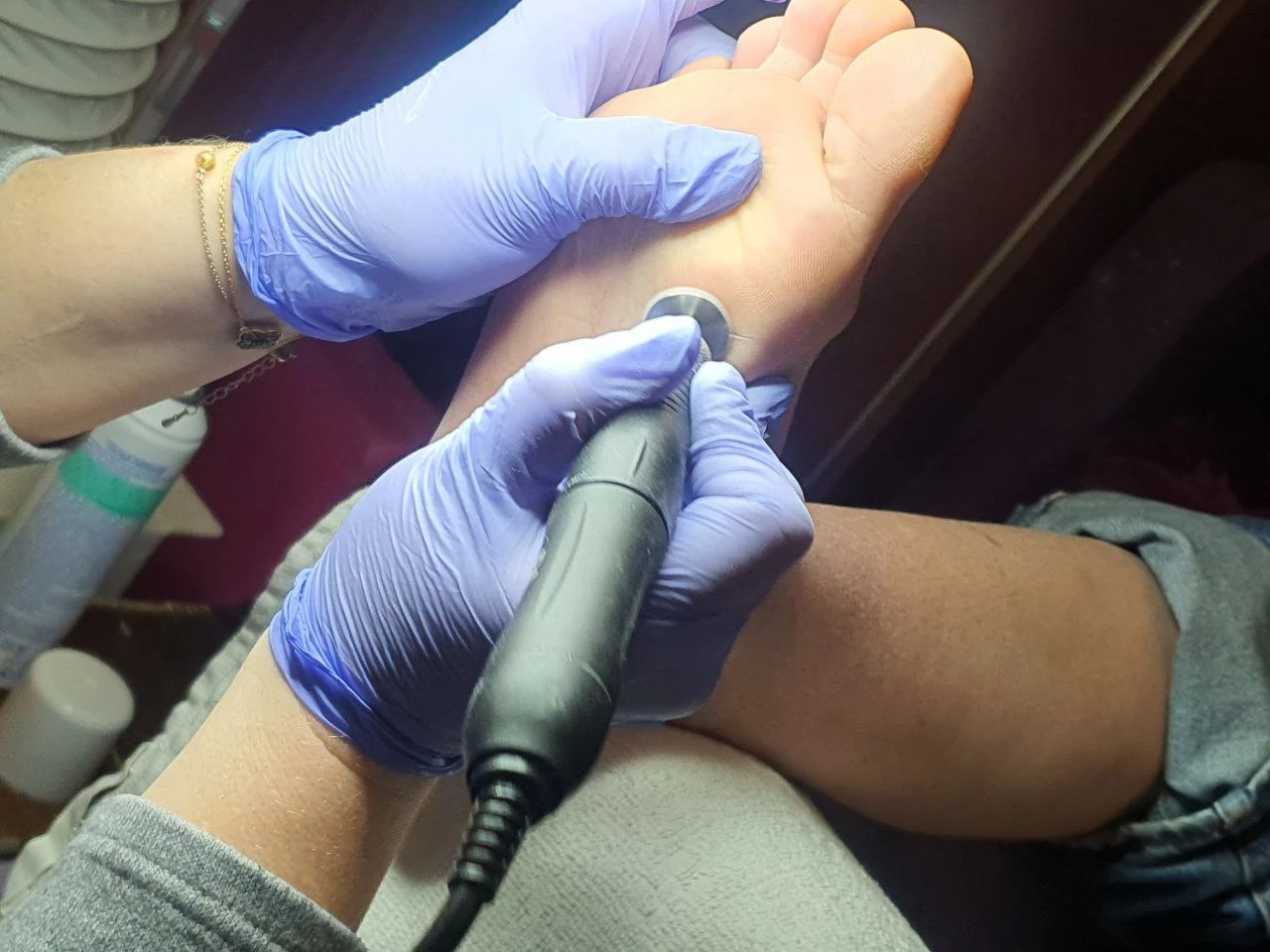 Удаление мозолей и натоптышей